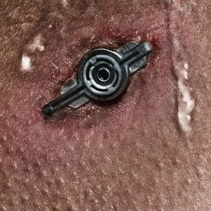 A close-up of human skin with a small, round, metallic object embedded in it, showing redness and irritation—a scene evocative of Neuromancer and the cyberpunk science fiction aesthetic.