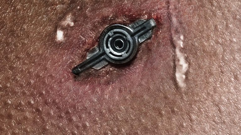 A close-up of human skin with a small, round, metallic object embedded in it, showing redness and irritation—a scene evocative of Neuromancer and the cyberpunk science fiction aesthetic.